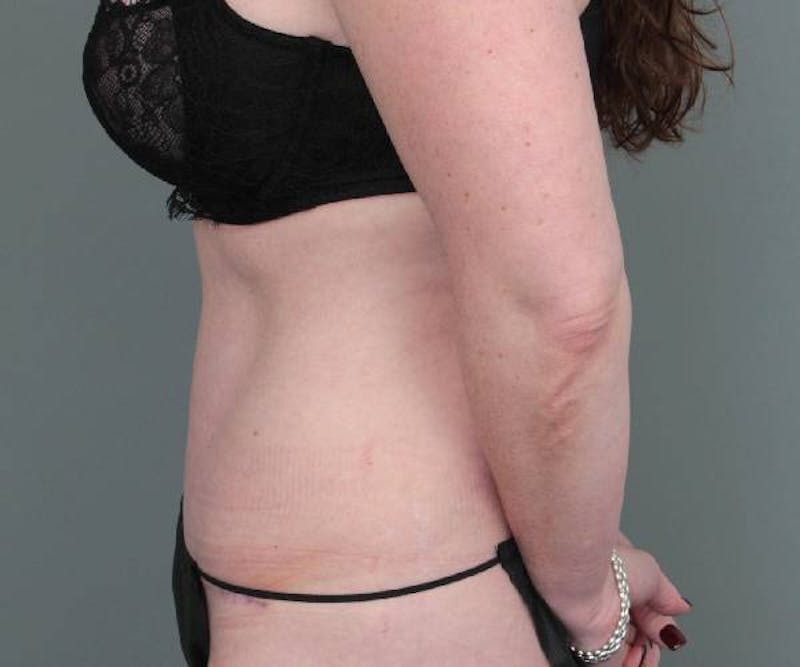 Tummy Tuck Before & After Gallery - Patient 203079 - Image 8 - Scott Chapin, MD