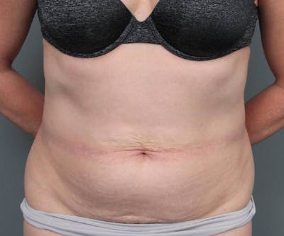 Tummy Tuck Before & After Gallery - Patient 220218 - Image 1 - Scott Chapin, MD