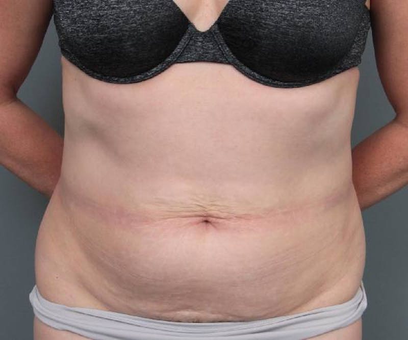 Tummy Tuck Before & After Gallery - Patient 220218 - Image 1 - Scott Chapin, MD