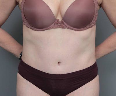 Tummy Tuck Before & After Gallery - Patient 220218 - Image 2 - Scott Chapin, MD
