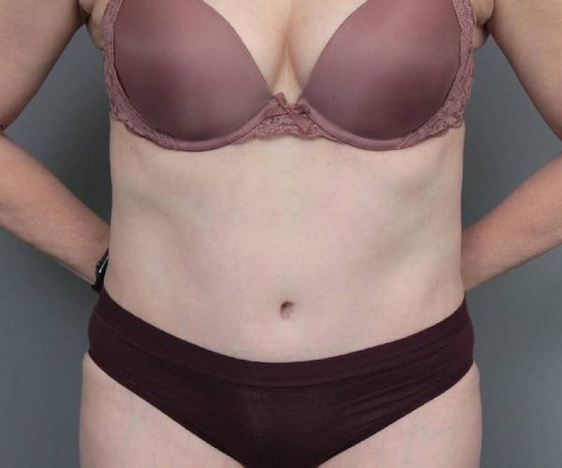 Tummy Tuck Before & After Gallery - Patient 220218 - Image 2 - Scott Chapin, MD