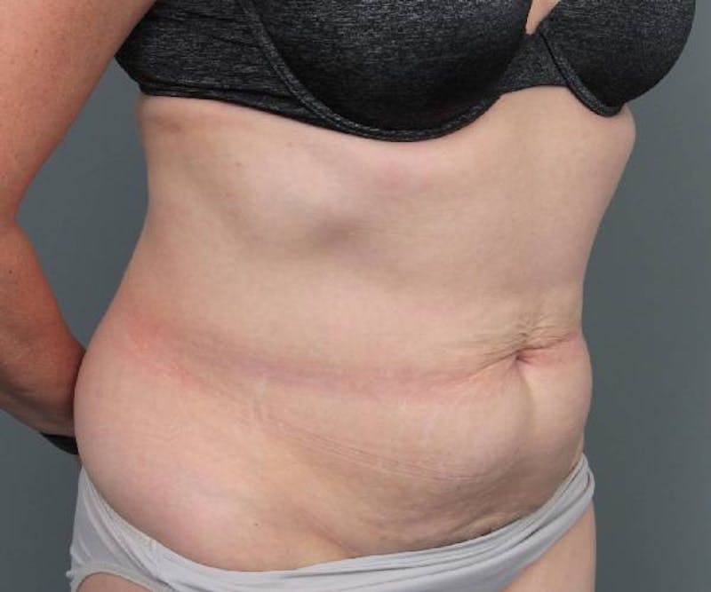 Tummy Tuck Before & After Gallery - Patient 220218 - Image 3 - Scott Chapin, MD