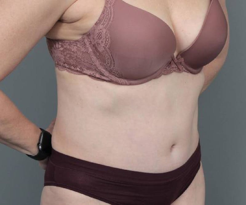 Tummy Tuck Before & After Gallery - Patient 220218 - Image 4 - Scott Chapin, MD