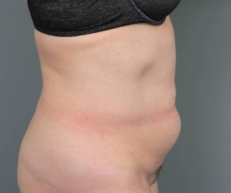 Tummy Tuck Before & After Gallery - Patient 220218 - Image 5 - Scott Chapin, MD