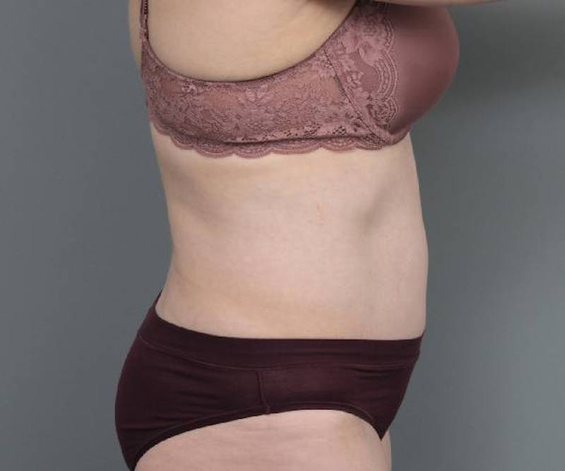 Tummy Tuck Before & After Gallery - Patient 220218 - Image 6 - Scott Chapin, MD