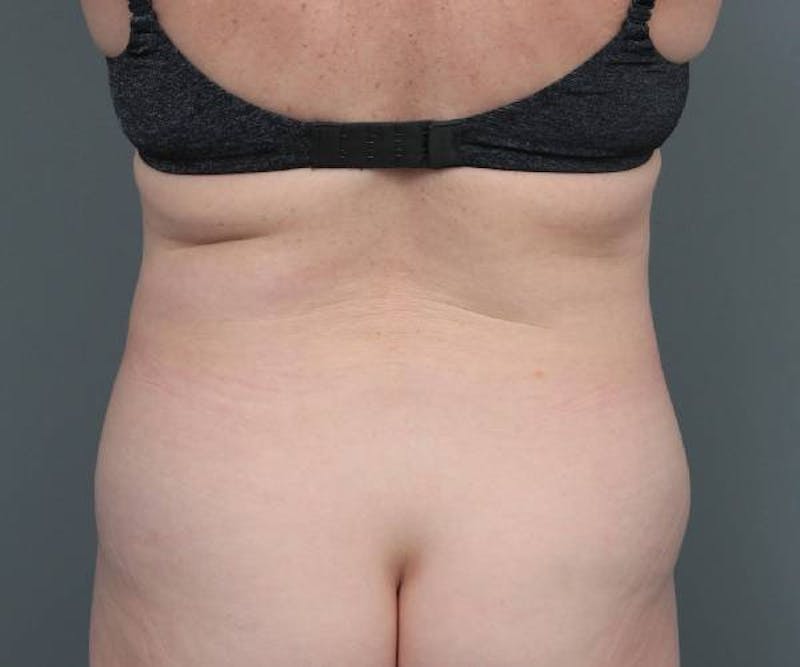 Tummy Tuck Before & After Gallery - Patient 220218 - Image 7 - Scott Chapin, MD
