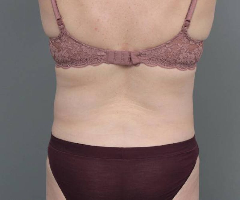 Tummy Tuck Before & After Gallery - Patient 220218 - Image 8 - Scott Chapin, MD