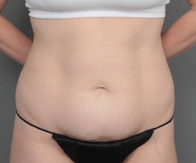 Tummy Tuck Before & After Gallery - Patient 427711 - Image 1 - Scott Chapin, MD