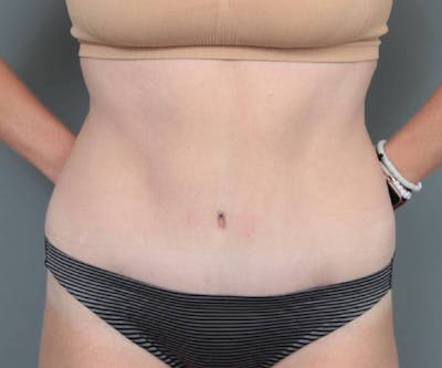 Tummy Tuck Before & After Gallery - Patient 427711 - Image 2 - Scott Chapin, MD