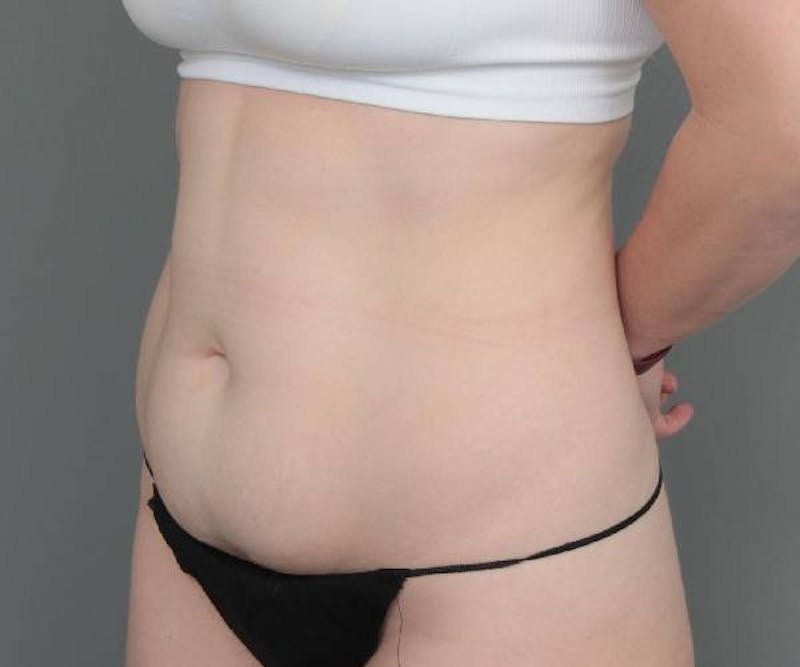 Tummy Tuck Before & After Gallery - Patient 427711 - Image 3 - Scott Chapin, MD