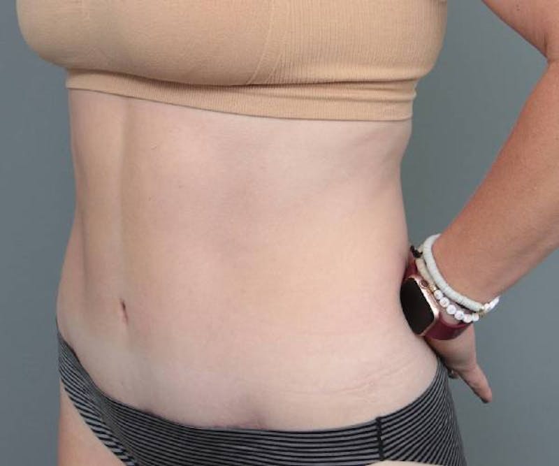 Tummy Tuck Before & After Gallery - Patient 427711 - Image 4 - Scott Chapin, MD