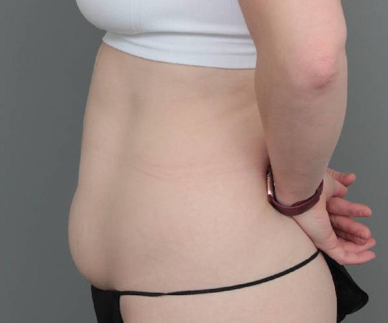 Tummy Tuck Before & After Gallery - Patient 427711 - Image 5 - Scott Chapin, MD