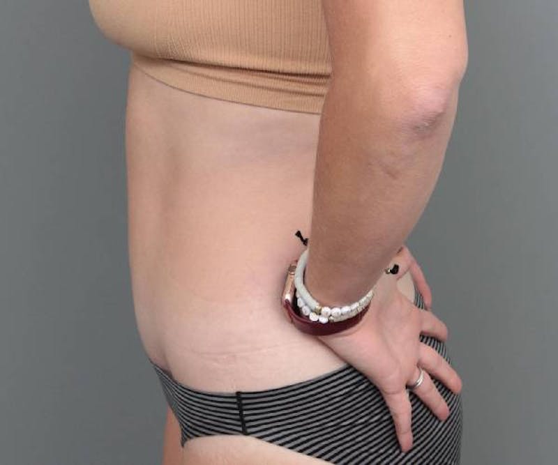 Tummy Tuck Before & After Gallery - Patient 427711 - Image 6 - Scott Chapin, MD