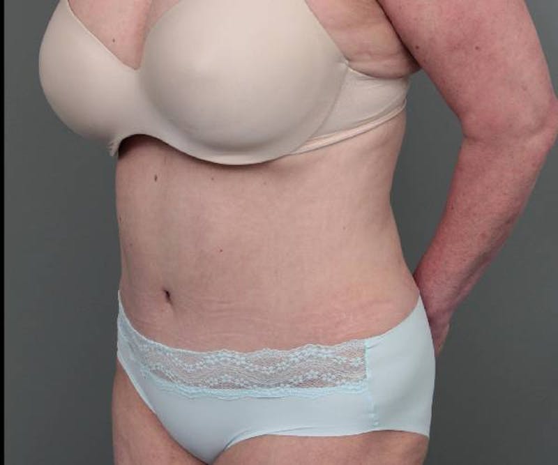 Tummy Tuck Before & After Gallery - Patient 303240 - Image 4 - Scott Chapin, MD