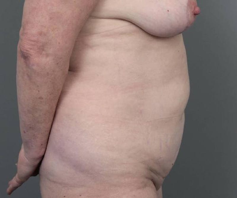 Tummy Tuck Before & After Gallery - Patient 303240 - Image 5 - Scott Chapin, MD