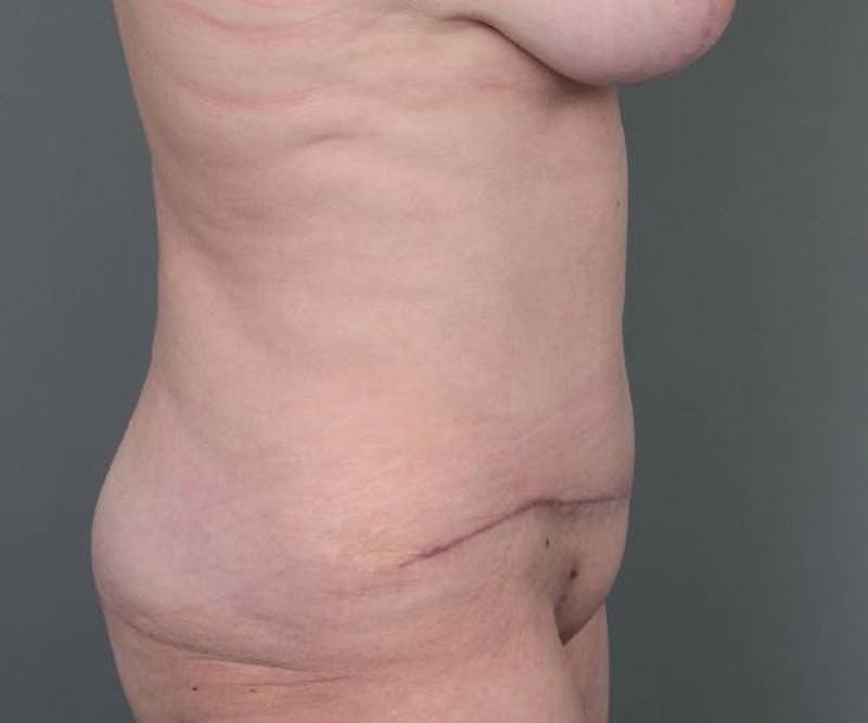 Tummy Tuck Before & After Gallery - Patient 303240 - Image 6 - Scott Chapin, MD