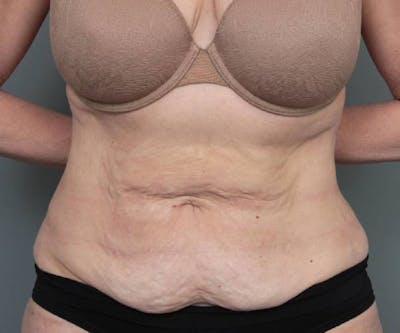 Tummy Tuck Before & After Gallery - Patient 303520 - Image 1 - Scott Chapin, MD
