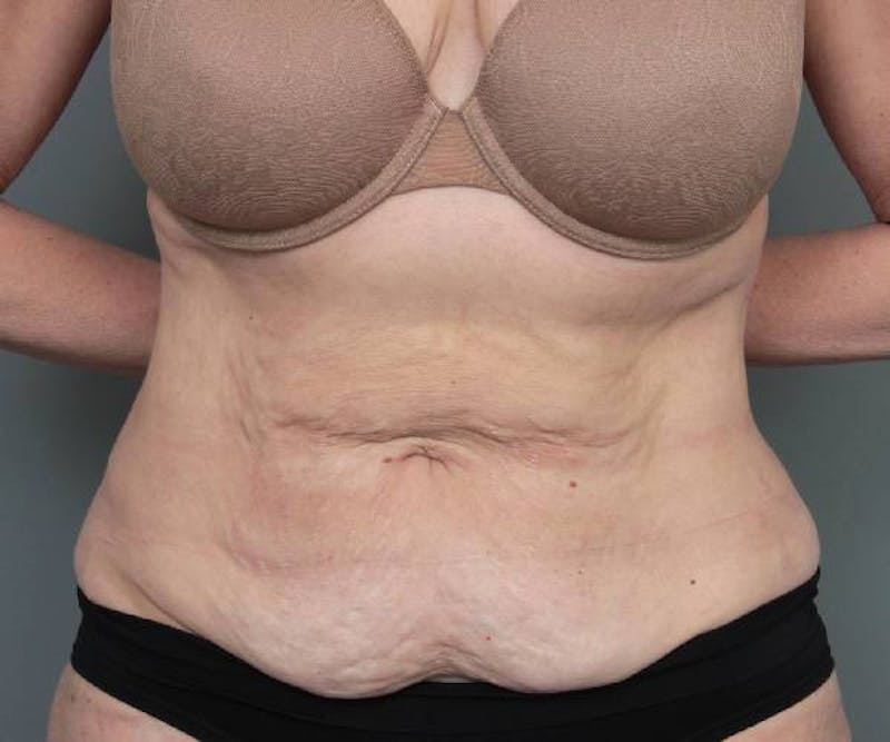 Tummy Tuck Before & After Gallery - Patient 303520 - Image 1 - Scott Chapin, MD