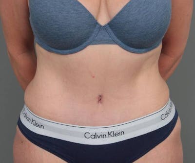 Tummy Tuck Before & After Gallery - Patient 303520 - Image 2 - Scott Chapin, MD
