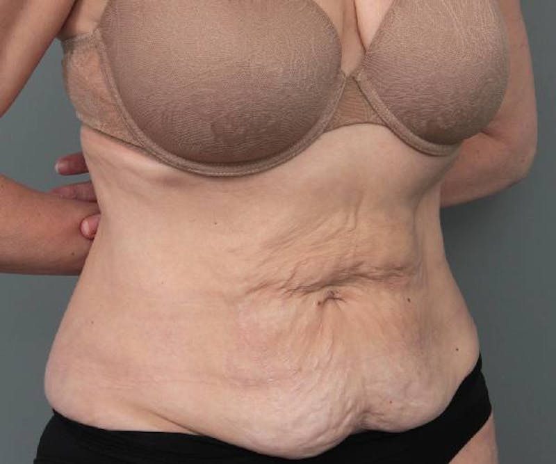 Tummy Tuck Before & After Gallery - Patient 303520 - Image 3 - Scott Chapin, MD