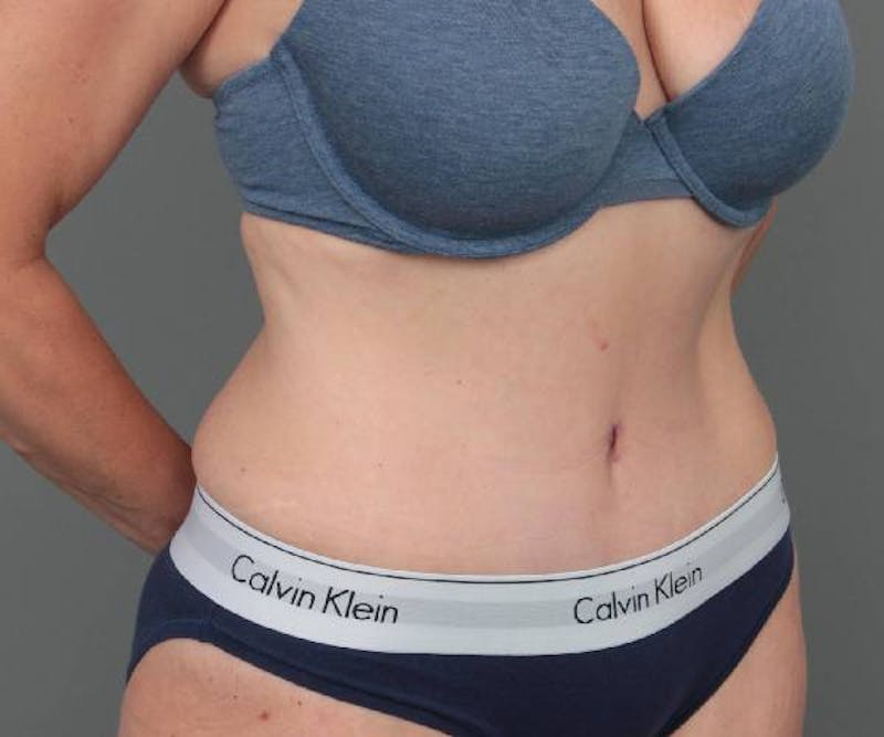 Tummy Tuck Before & After Gallery - Patient 303520 - Image 4 - Scott Chapin, MD