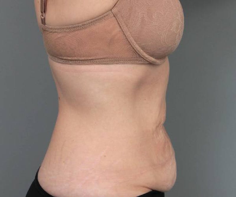 Tummy Tuck Before & After Gallery - Patient 303520 - Image 5 - Scott Chapin, MD
