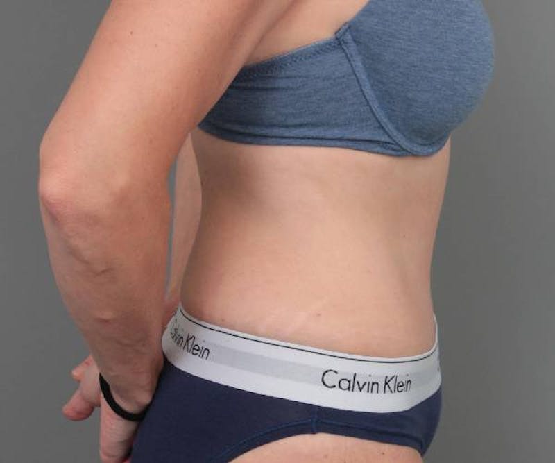 Tummy Tuck Before & After Gallery - Patient 303520 - Image 6 - Scott Chapin, MD