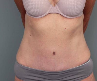 Tummy Tuck Before & After Gallery - Patient 348456 - Image 2 - Scott Chapin, MD