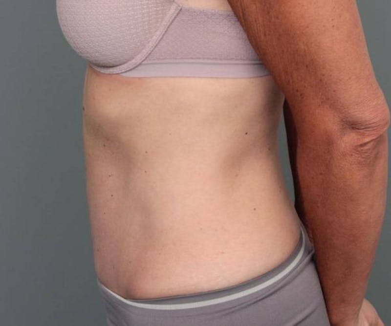 Tummy Tuck Before & After Gallery - Patient 348456 - Image 4 - Scott Chapin, MD