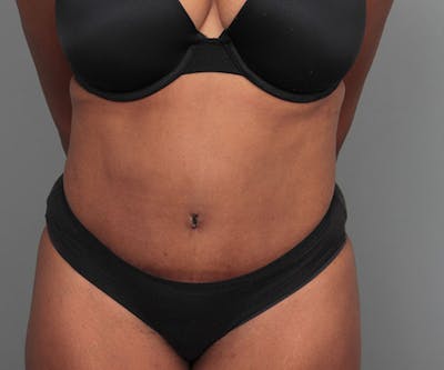 Tummy Tuck Before & After Gallery - Patient 142194 - Image 2 - Scott Chapin, MD