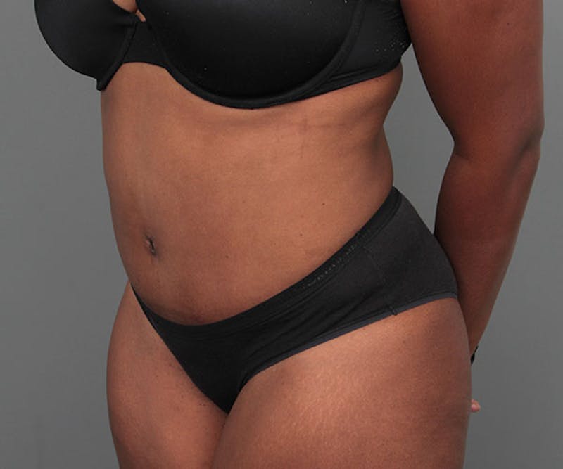 Tummy Tuck Before & After Gallery - Patient 142194 - Image 4 - Scott Chapin, MD