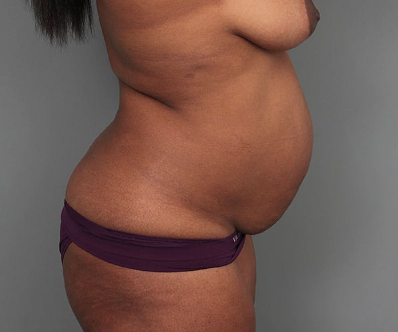 Tummy Tuck Before & After Gallery - Patient 142194 - Image 5 - Scott Chapin, MD