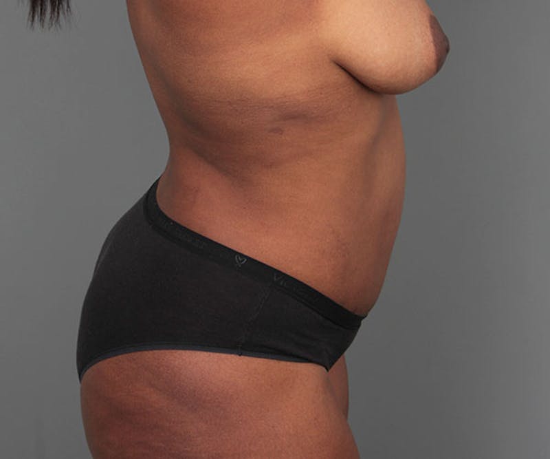 Tummy Tuck Before & After Gallery - Patient 142194 - Image 6 - Scott Chapin, MD