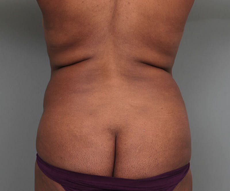 Tummy Tuck Before & After Gallery - Patient 142194 - Image 7 - Scott Chapin, MD