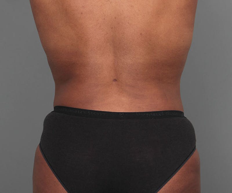Tummy Tuck Before & After Gallery - Patient 142194 - Image 8 - Scott Chapin, MD