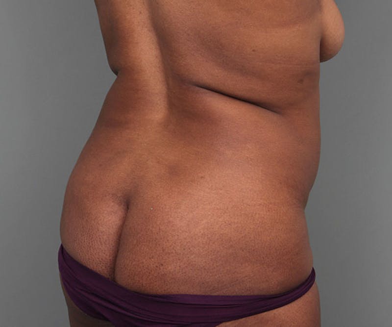 Tummy Tuck Before & After Gallery - Patient 142194 - Image 9 - Scott Chapin, MD