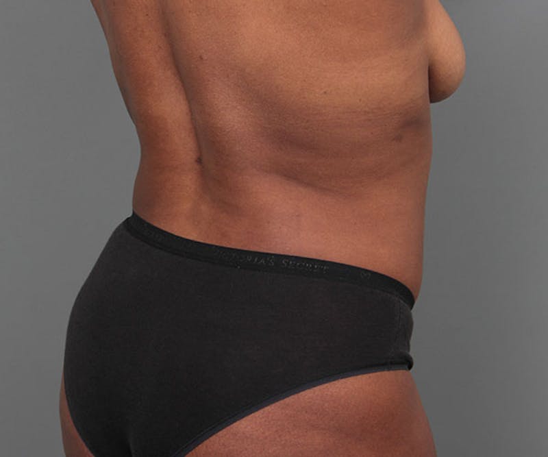 Tummy Tuck Before & After Gallery - Patient 142194 - Image 10 - Scott Chapin, MD