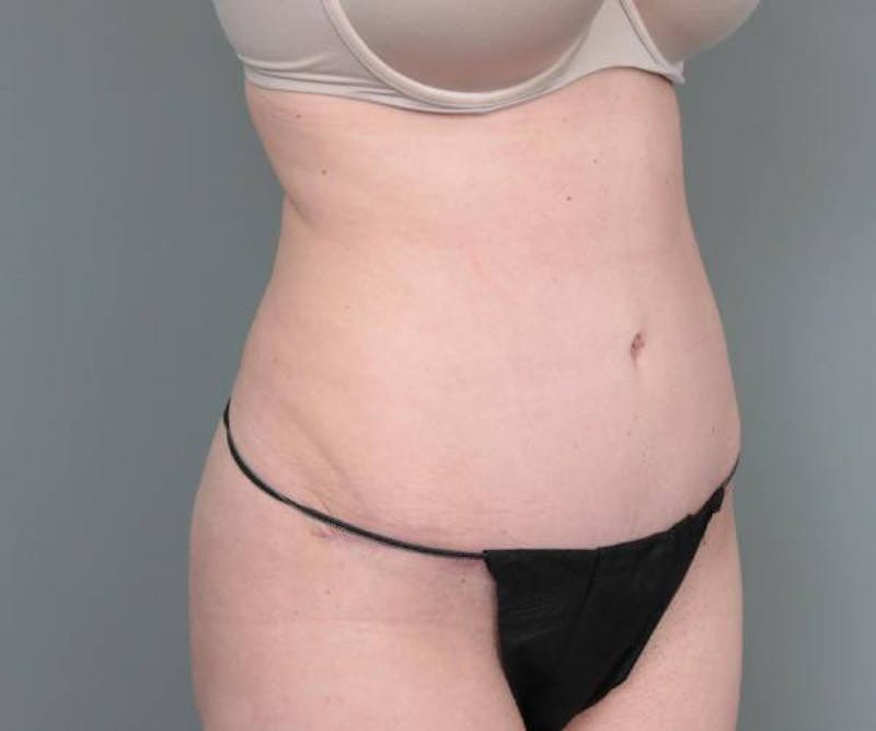 Tummy Tuck Before & After Gallery - Patient 312993 - Image 4 - Scott Chapin, MD