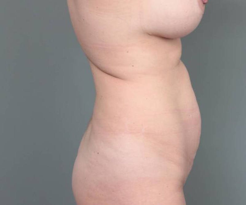 Tummy Tuck Before & After Gallery - Patient 312993 - Image 5 - Scott Chapin, MD