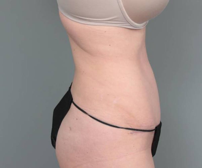 Tummy Tuck Before & After Gallery - Patient 312993 - Image 6 - Scott Chapin, MD