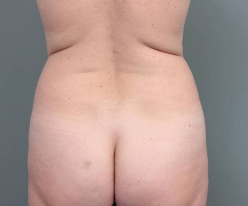 Tummy Tuck Before & After Gallery - Patient 312993 - Image 7 - Scott Chapin, MD