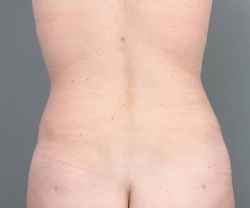 Tummy Tuck Before & After Gallery - Patient 312993 - Image 8 - Scott Chapin, MD