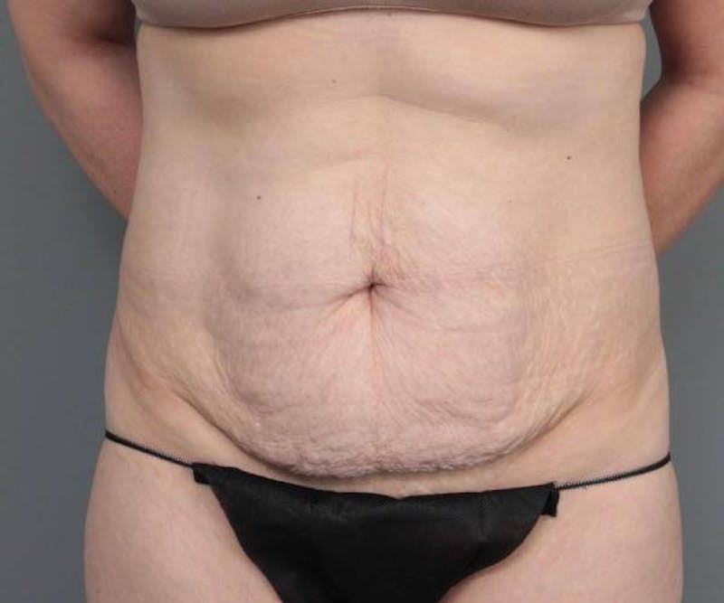 Tummy Tuck Before & After Gallery - Patient 205348 - Image 1 - Scott Chapin, MD