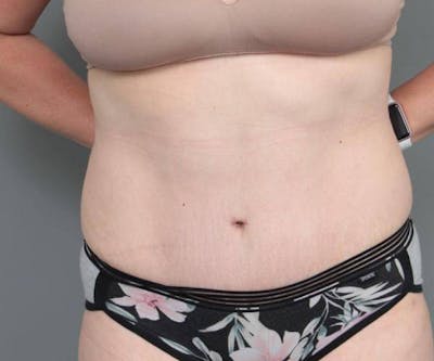 Tummy Tuck Before & After Gallery - Patient 205348 - Image 2 - Scott Chapin, MD
