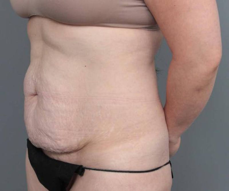 Tummy Tuck Before & After Gallery - Patient 205348 - Image 3 - Scott Chapin, MD