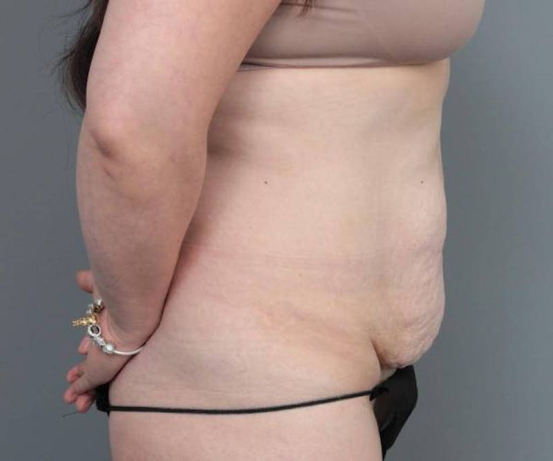Tummy Tuck Before & After Gallery - Patient 205348 - Image 5 - Scott Chapin, MD