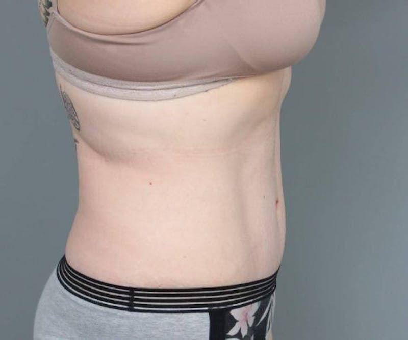 Tummy Tuck Before & After Gallery - Patient 205348 - Image 6 - Scott Chapin, MD