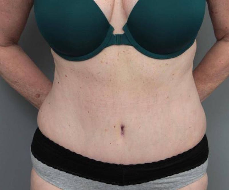 Tummy Tuck Before & After Gallery - Patient 367679 - Image 2 - Scott Chapin, MD