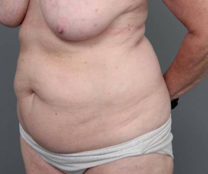 Tummy Tuck Before & After Gallery - Patient 367679 - Image 3 - Scott Chapin, MD