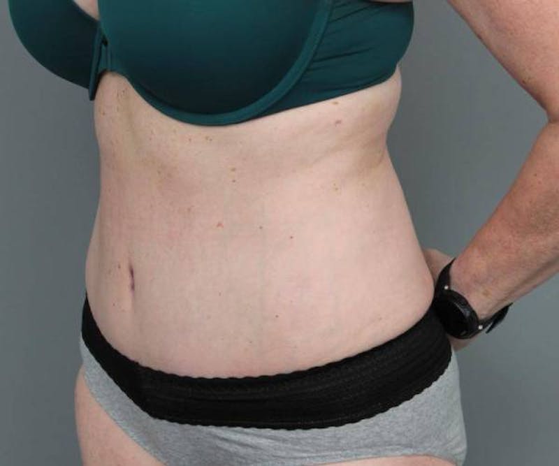 Tummy Tuck Before & After Gallery - Patient 367679 - Image 4 - Scott Chapin, MD